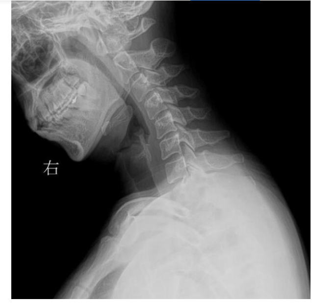 患者应常规拍摄颈椎正侧位,过伸过屈侧位x线片;临床以相邻椎体之间成