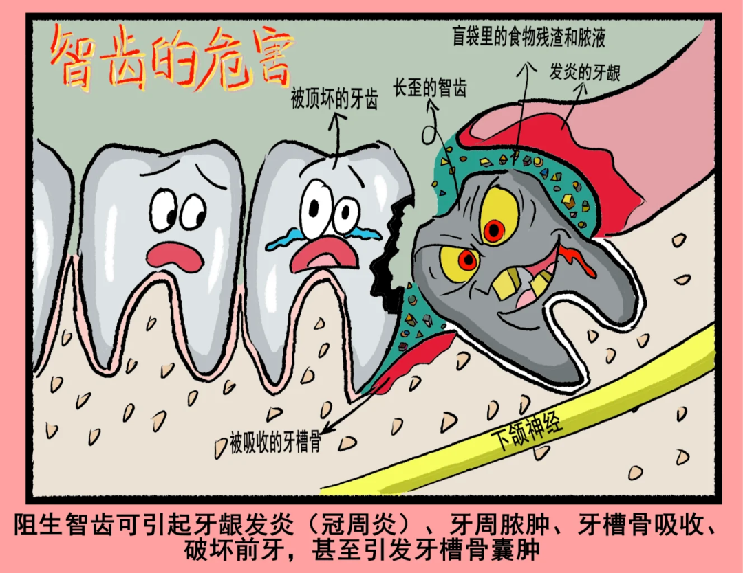 智齿冠周炎：年轻人的