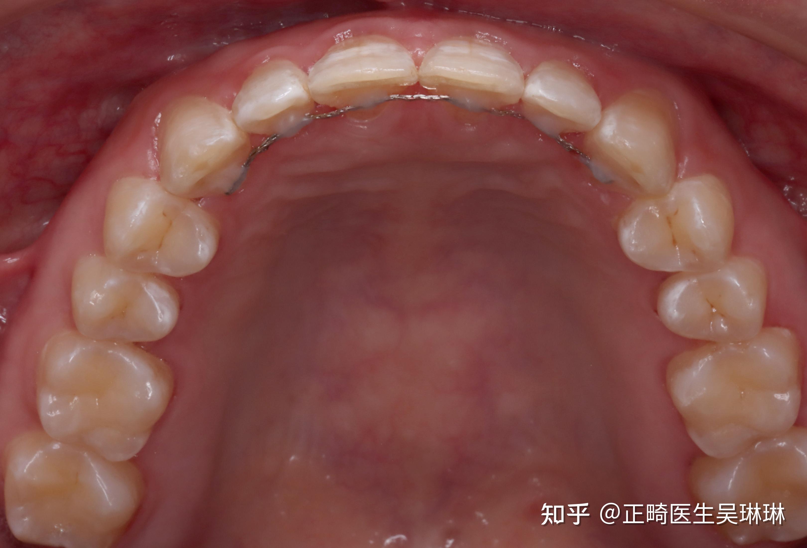 42. 下颌骨(前面观)-颌面口腔应用解剖-医学