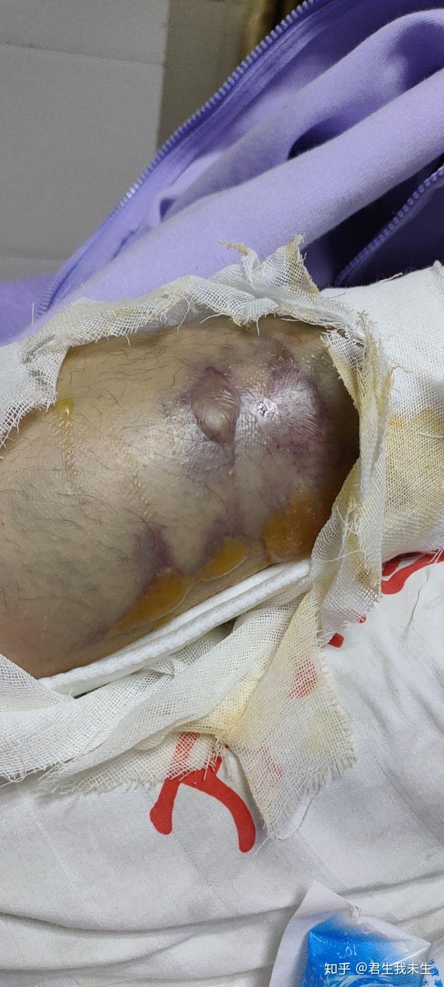 胫腓骨粉碎性骨折后如何康复持续更新