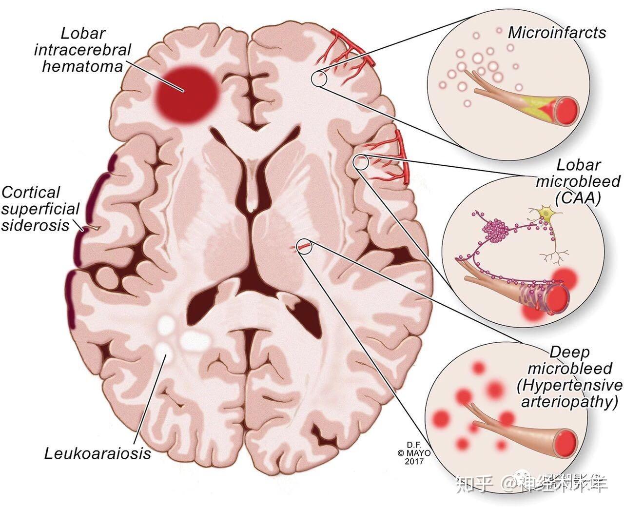 右侧大脑中动脉闭塞血管内治疗一例 - 脑医汇 - 神外资讯 - 神介资讯