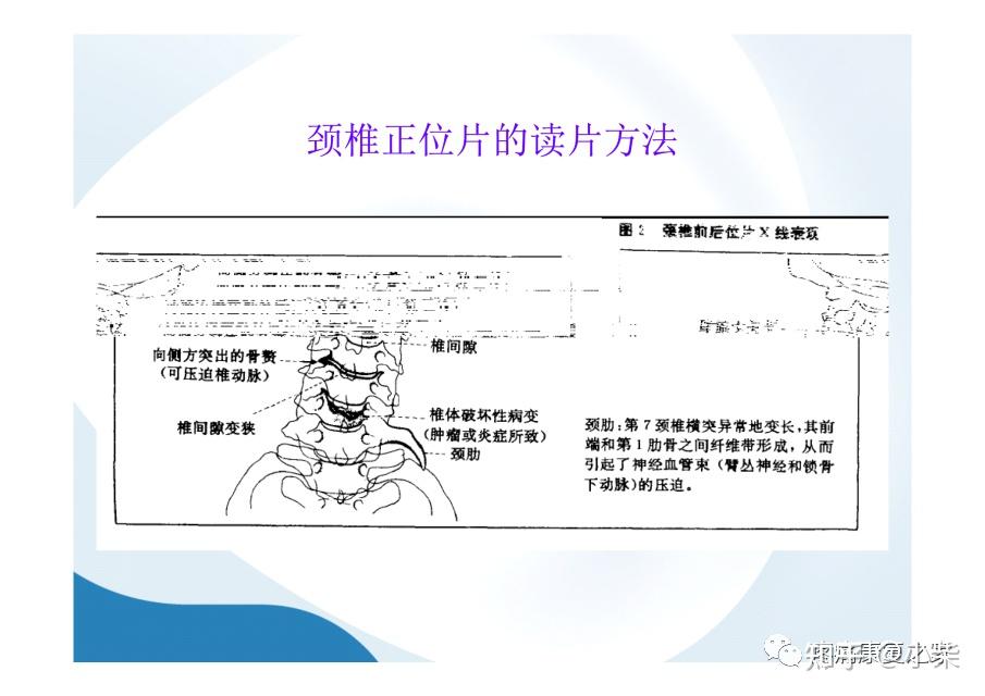 1,侧位椎间孔挤压测试检查者位于患者的后面,患者坐位,头向患侧倾斜并