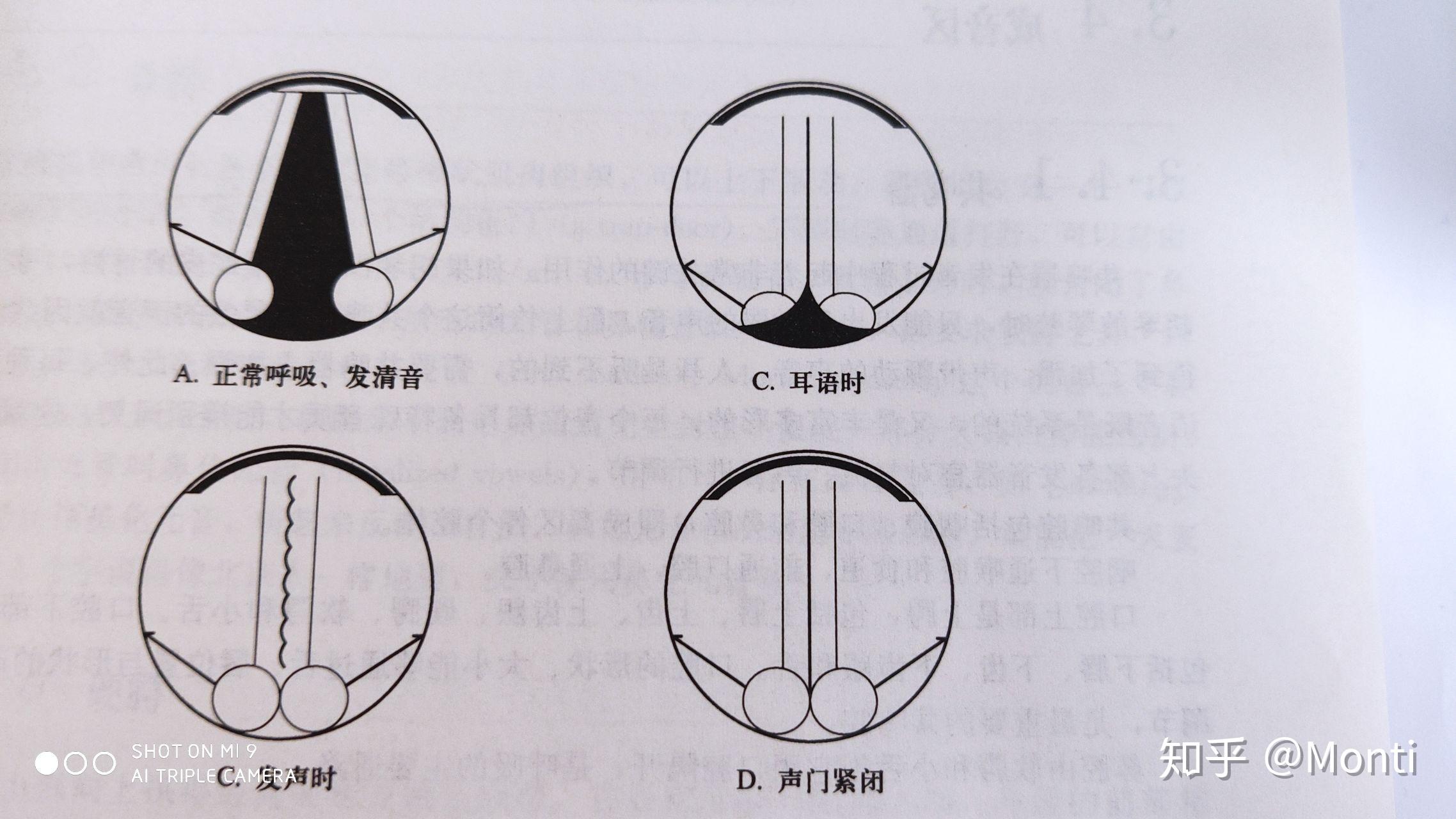 c,声带完全闭合,肺部气流积聚在声门下面形成一股压力,冲开声带,压力