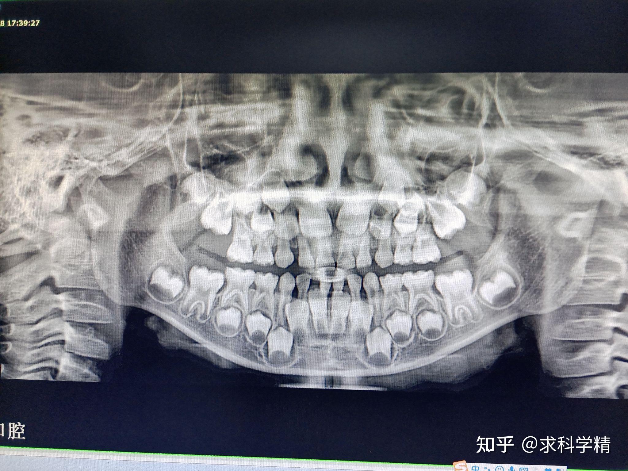 标准牙齿ct图侧面图片