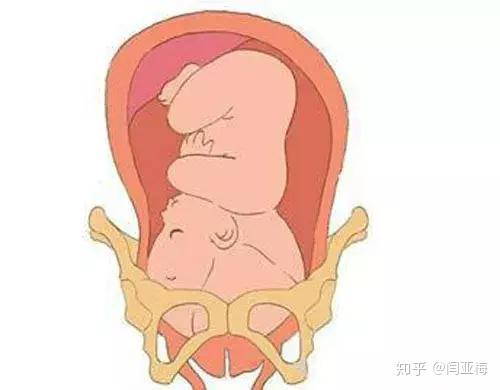 临产后由于子宫收缩推动胎头入盆,其中小部分可能发生胎位不正,甚至