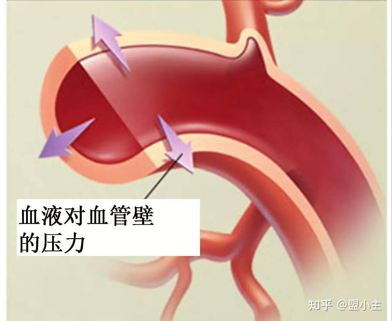动态血压监测:高血压精准管理的 “侦察兵” - 知乎