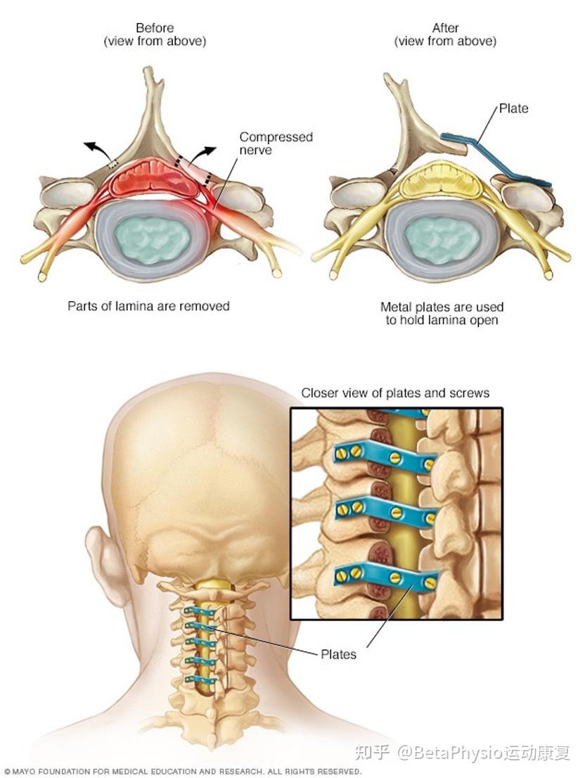 椎管狭窄Spinal stenosis-顺德康复 - 知乎