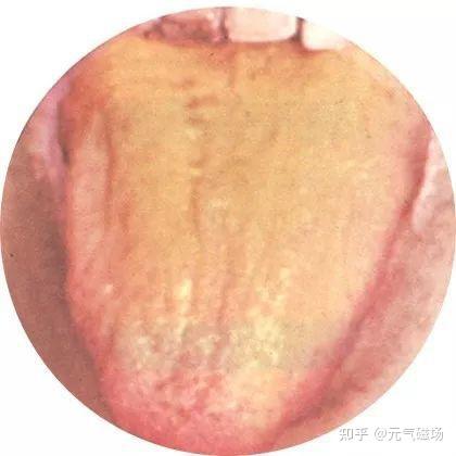 中医舌诊（一）高清版 - 知乎