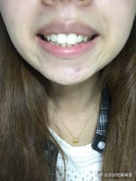 上颌骨大于下颌骨时,脸型看起来是偏凸面型的.
