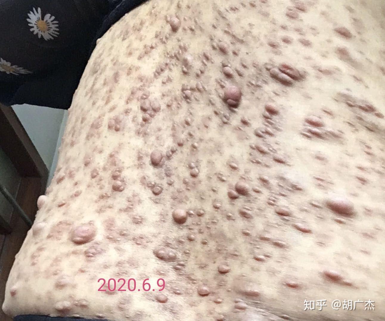 神经纤维瘤调理案例实时报道2