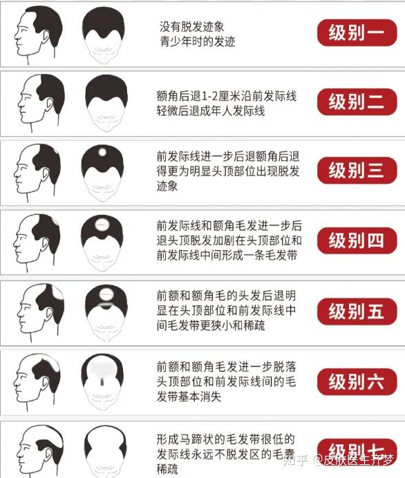 权威期刊《中国秃发指南》发布:预防防脱首选人参提取物! - 知乎