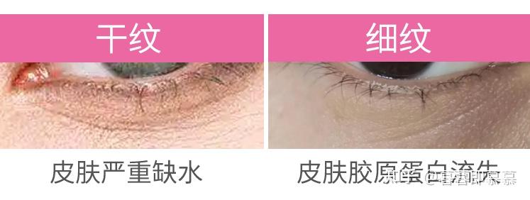 眼睛下眼角有已经形成的干纹和细纹的区别?怎么产生的怎么消除? - 知乎