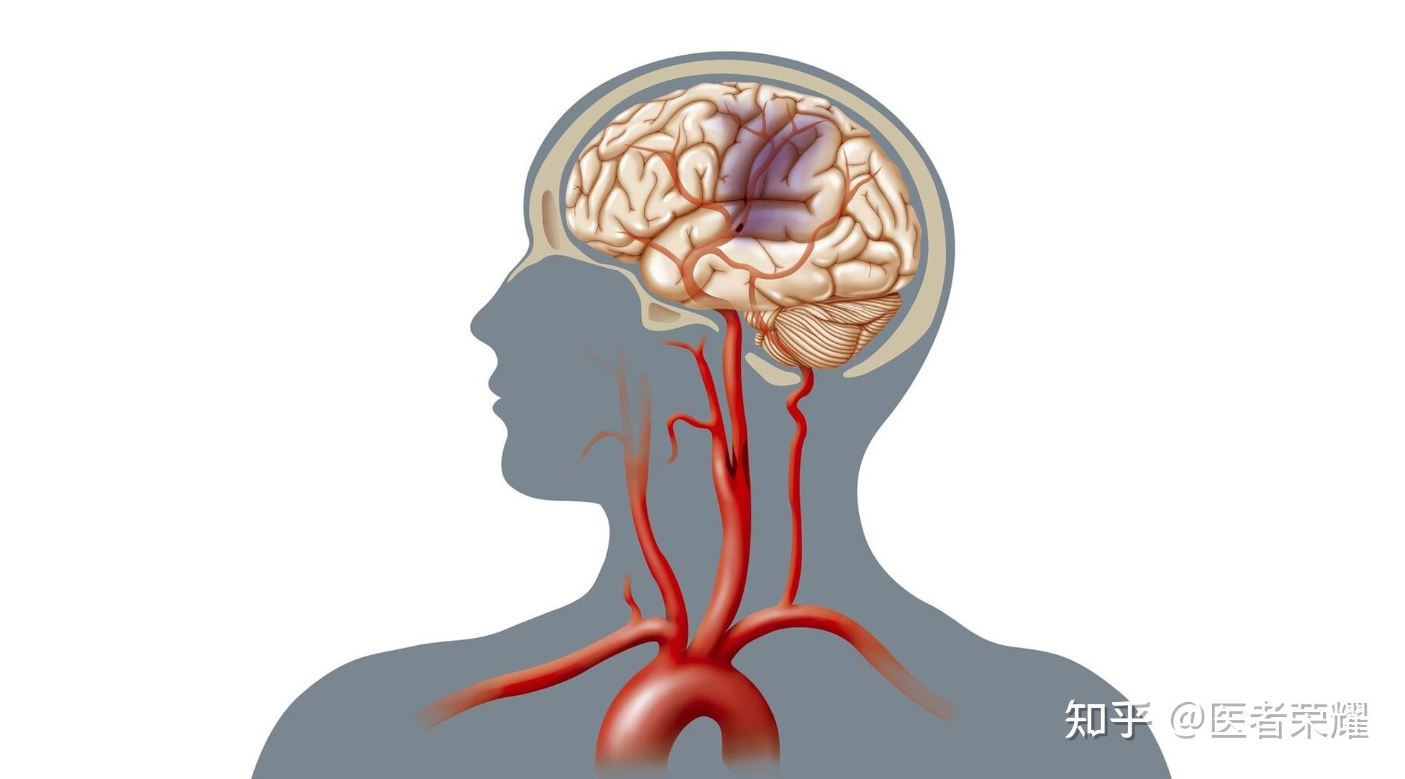 因此,經常打哈欠往往預示著近期可能發生缺血性腦血管病.2.