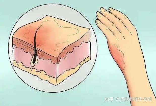 伤口愈合后红色凸起疤痕怎么治疗?