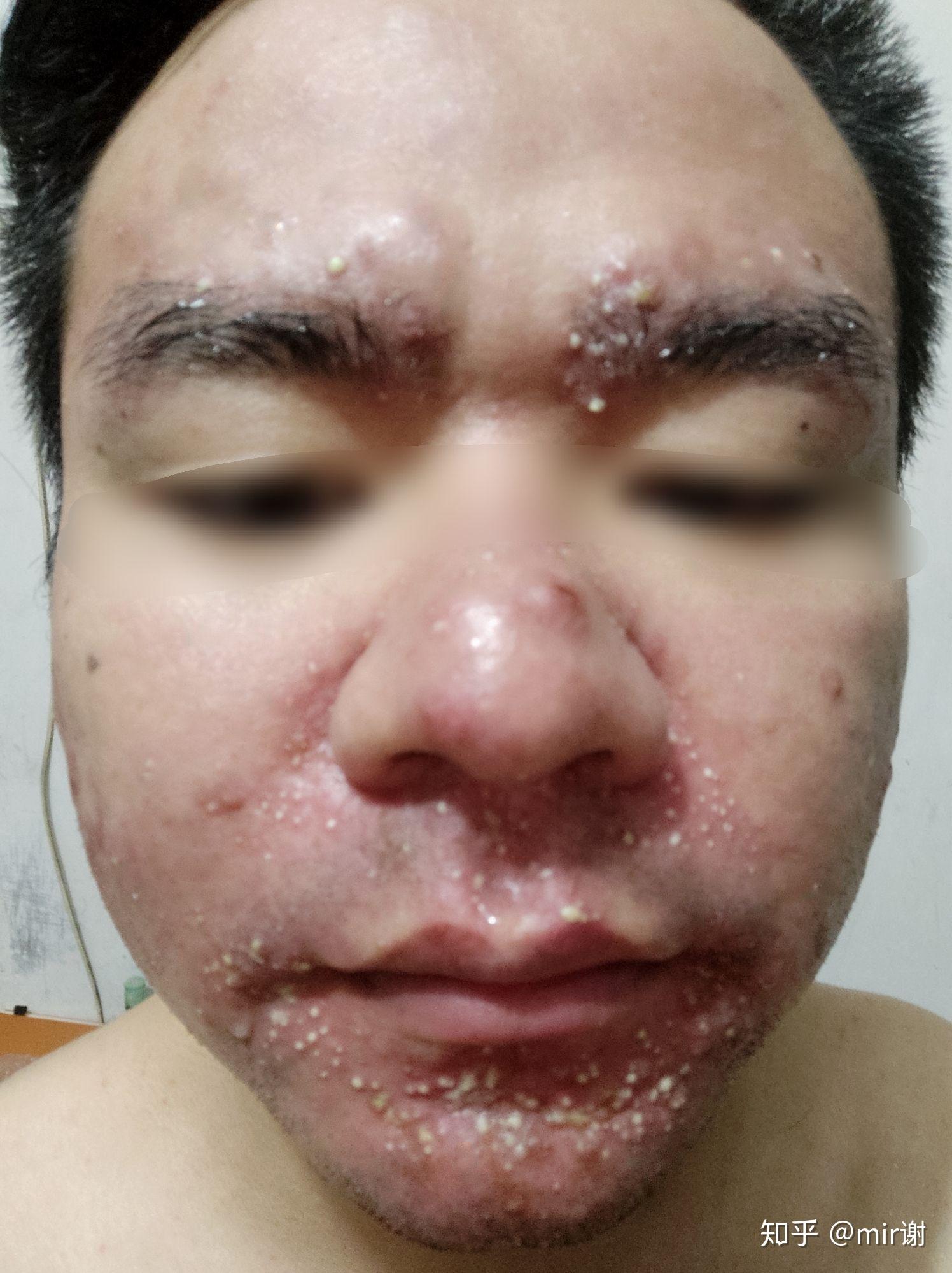 光动力治疗痤疮全记录