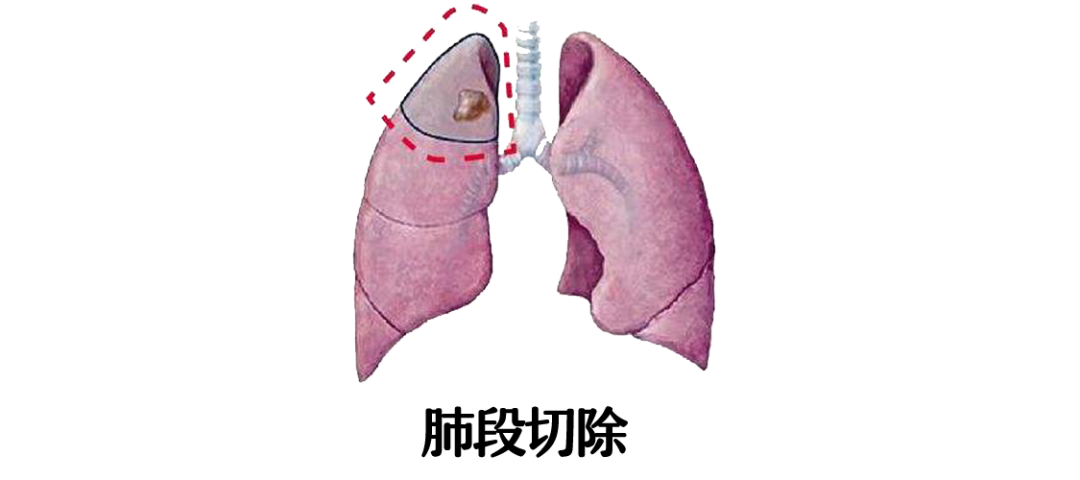 1 切肺边缘一小块这种手术叫"楔形切除"术.