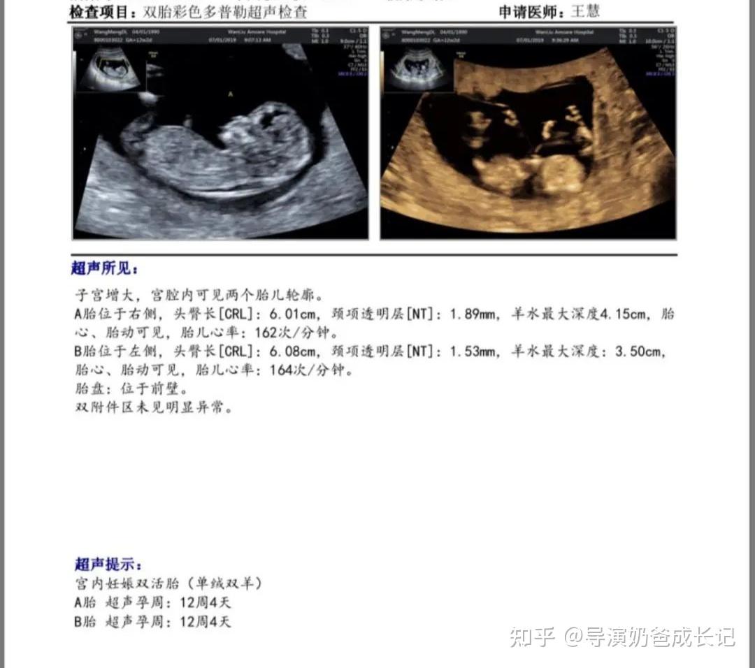 图18～39 少见的单卵双胎-功能组织学与胚胎学-医学