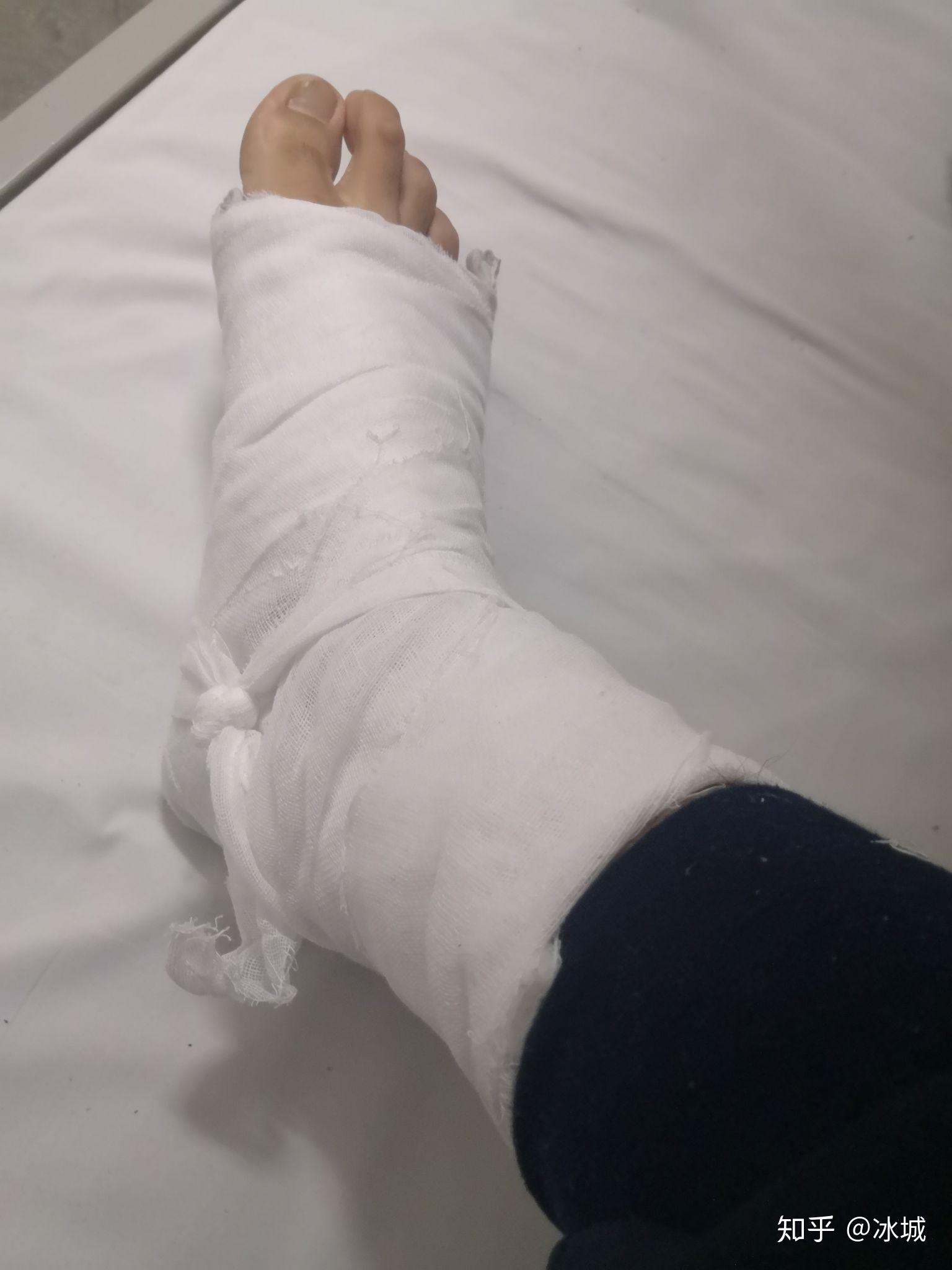 右脚第五跖骨骨折日记