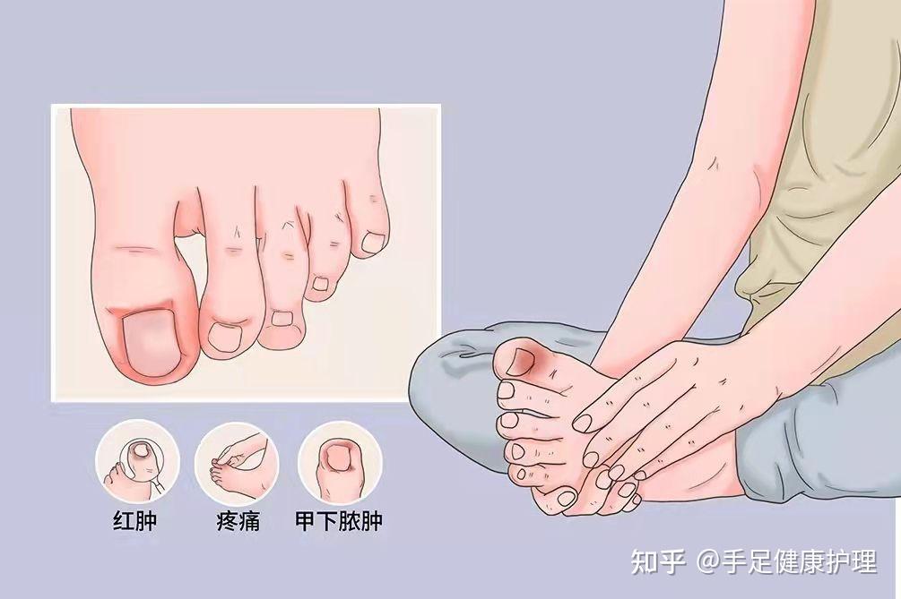 甲沟炎的影响以及危害有哪些简短的说下