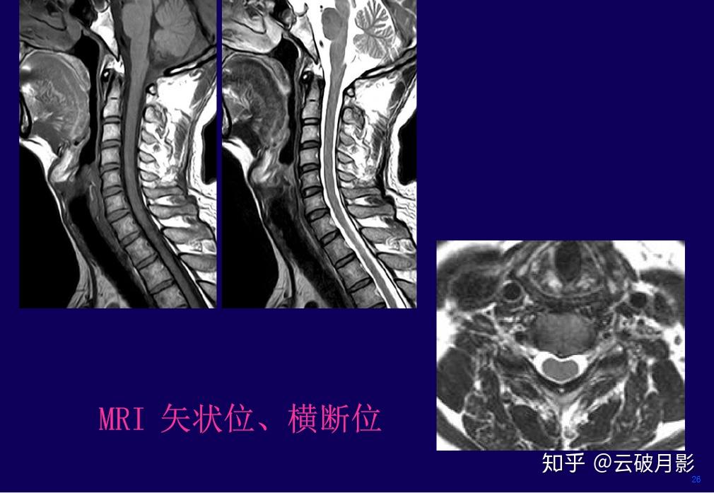 得颈椎病的人视频 v2-cf0b04e402c89b5d9334dd97256a41a9_r.jpg