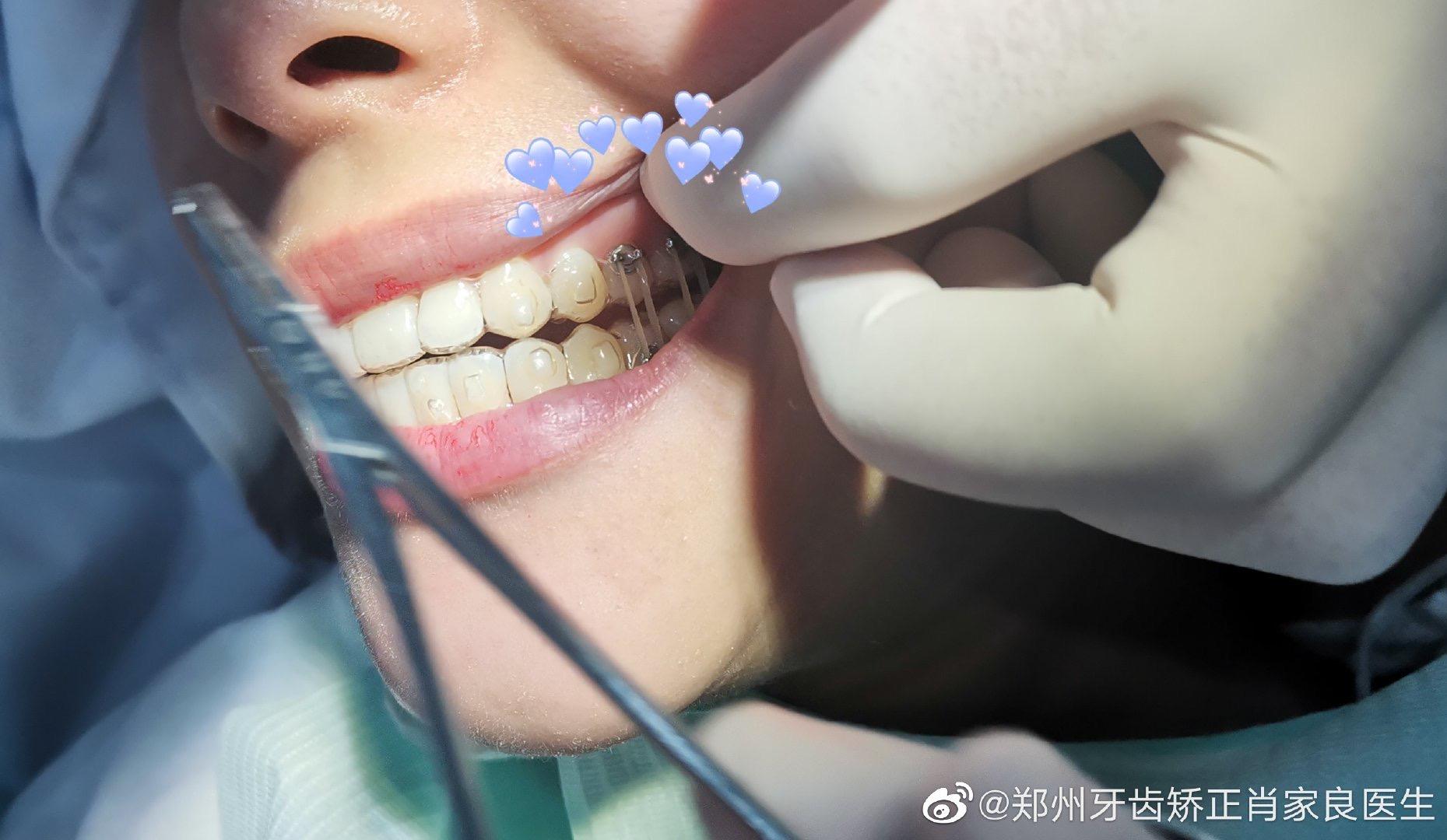 改善牙齿中线不正影响到美观73关闭间隙:小小的皮筋,拥有神奇的力量