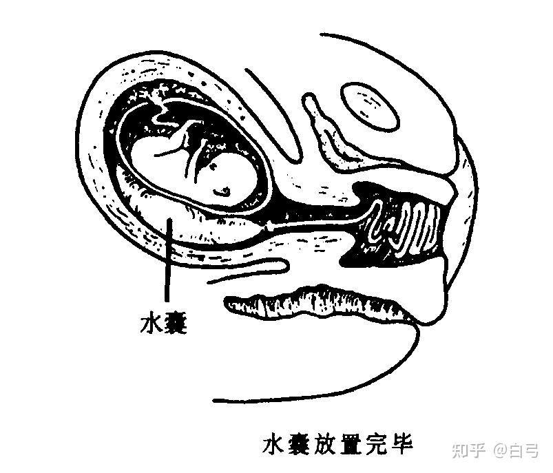 顺产塞球囊图片图片