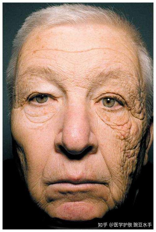 紫外线对皮肤的伤害