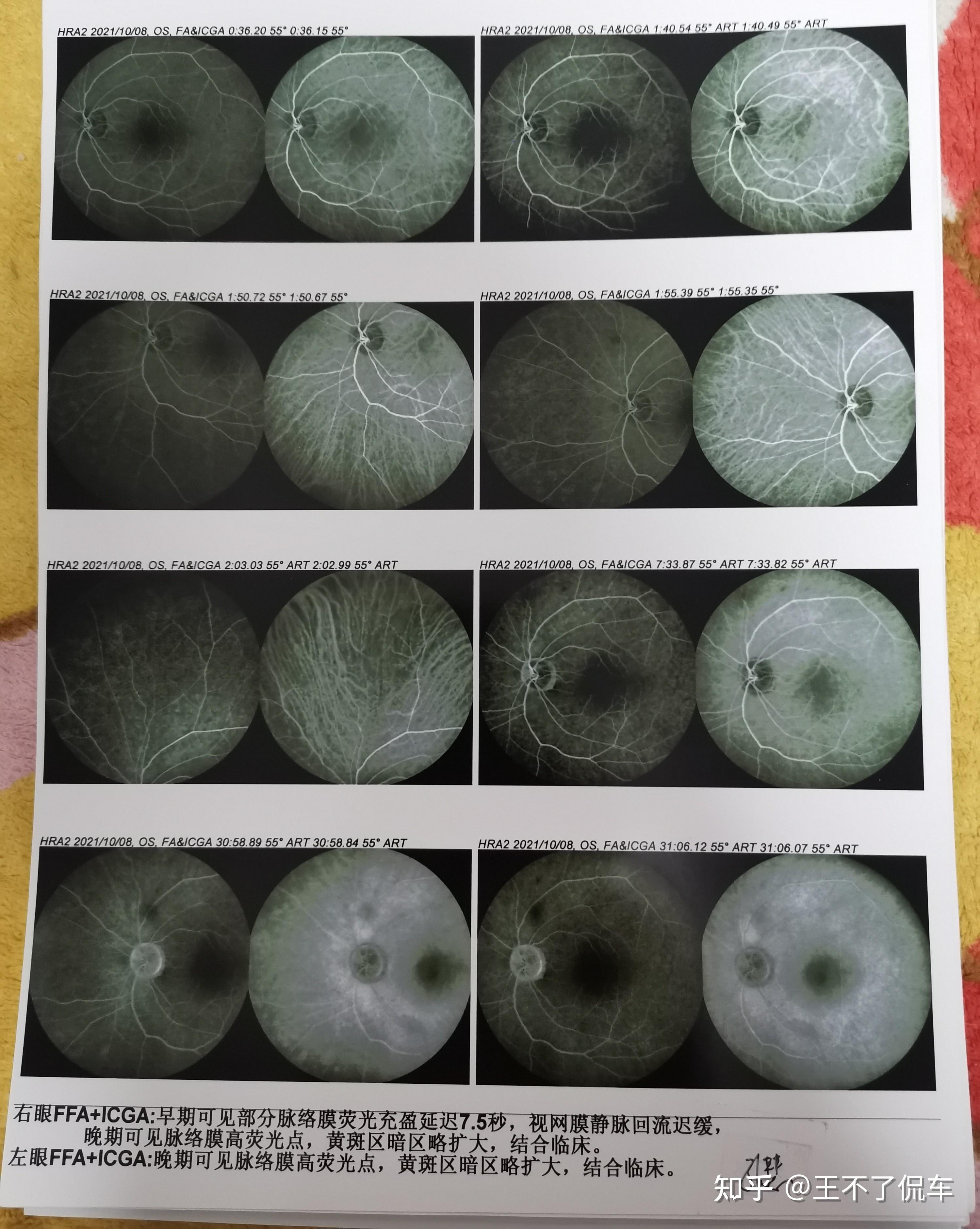 发病两年即将失明,找不出病因的双眼视神经萎缩,求助 - 知乎