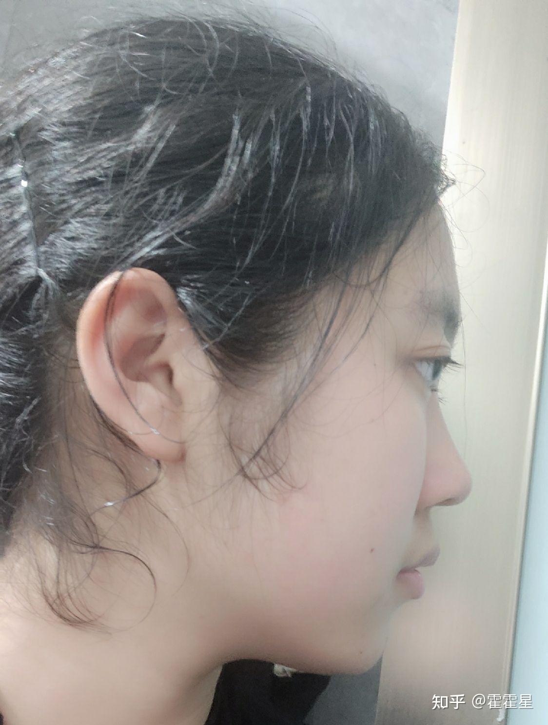 侧面看眼睛非常突,眉骨低和鼻子连接不起来是怎么回事?