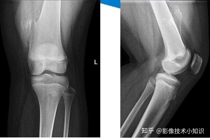 骨癌片子图片