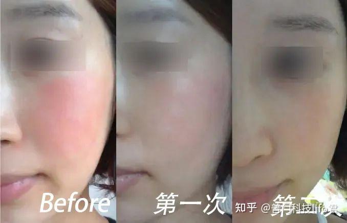 亲测 || 一款专业的红蓝黄光治疗仪器能给皮肤带来哪些改变？ - 知乎