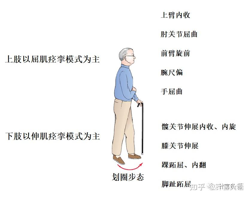 中风系列│何天有教授 中风痉挛期针刺法