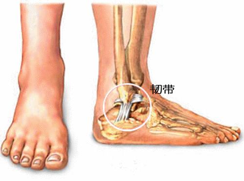 脚踝扭伤看似简单为啥总有人处理不好医家人运动康复