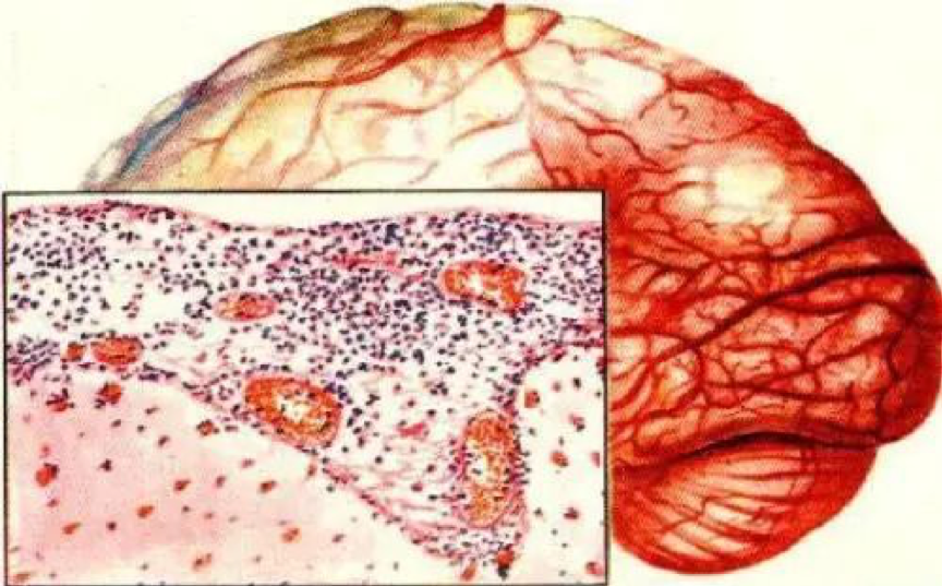 简称流脑,是由脑膜炎球菌引起的呼吸道传播的一种化脓性脑膜炎