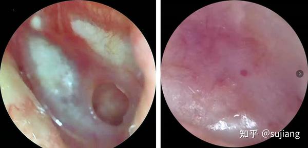耳朵钙化图片图片