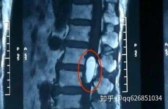 常见的腰痛原因有哪些 知乎