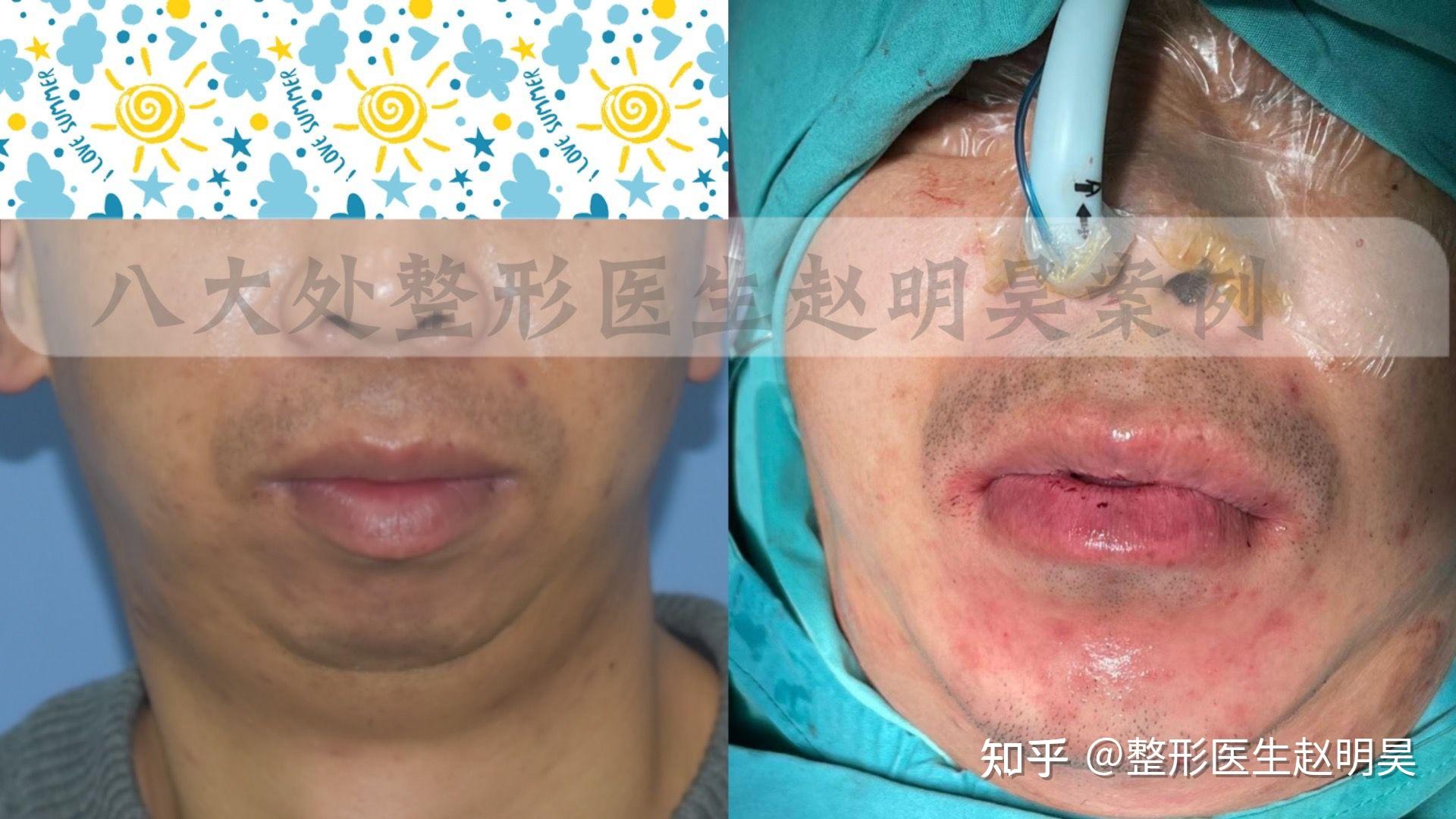 小颌畸形-鸟嘴状畸形