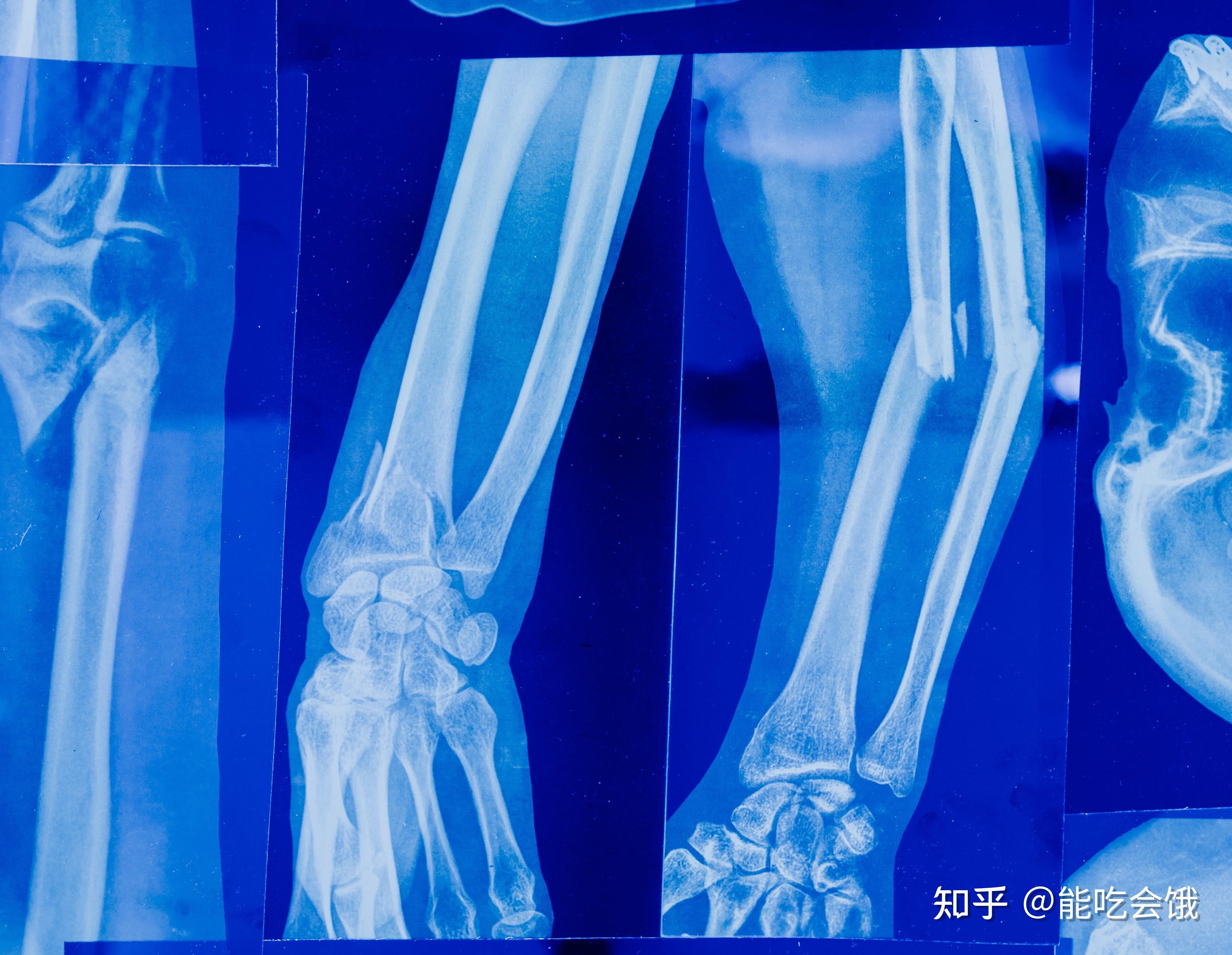 缺钙腿抽筋 钙多肾结石 专家教你正确补钙|肾结石_新浪新闻