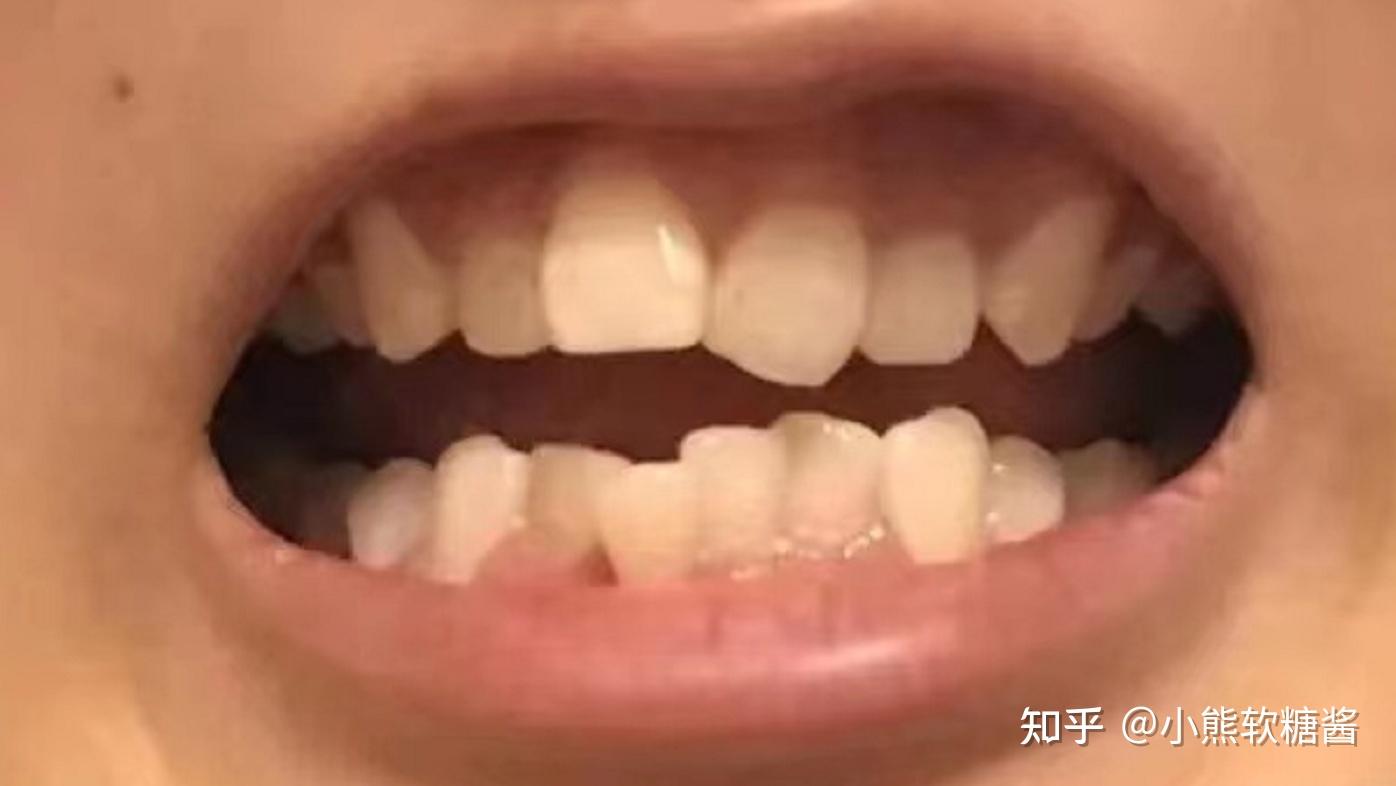 北京牙齿矫正 | 儿童青少年牙齿矫正，佩戴金属牙套好还是隐形牙套好？ - 知乎