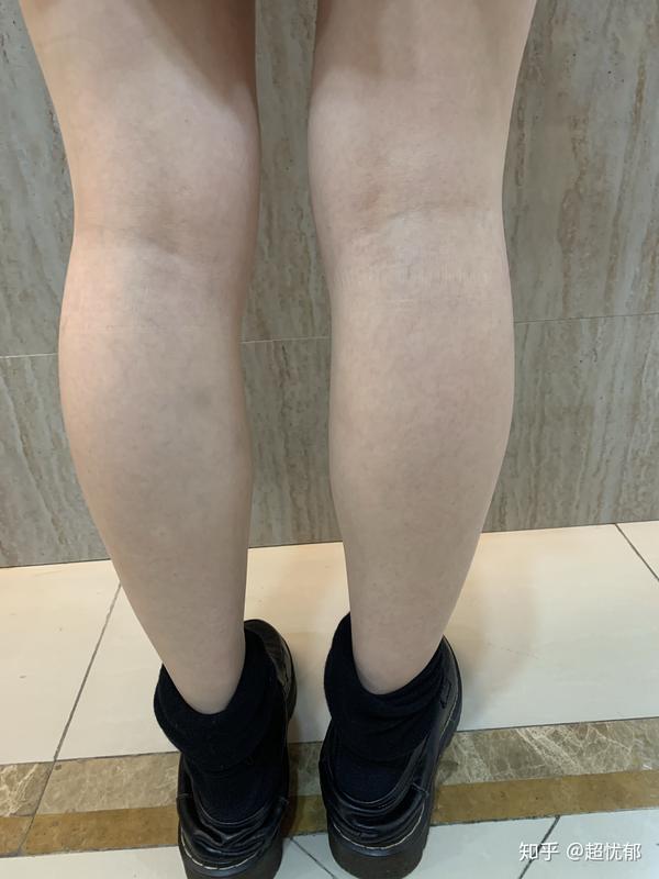 肌肉外翻畸形腿打瘦腿针有用吗