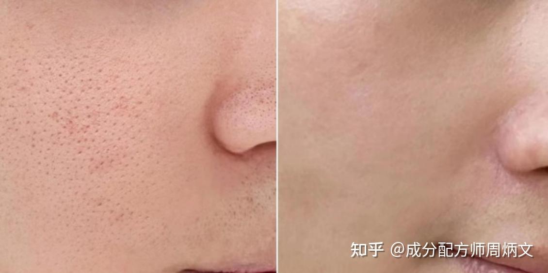 【男生毛孔粗大必看】脸上密密麻麻都是粗大的毛孔,应该如何改善?医学生教你四步轻松解决,将毛孔粗大一网打尽!