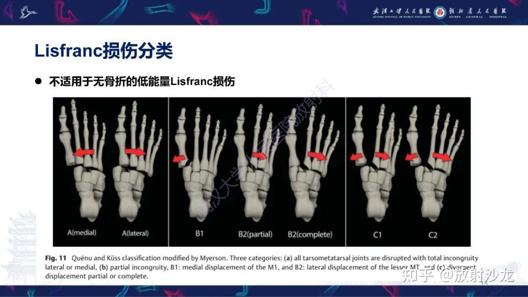 lisfranc关节图片