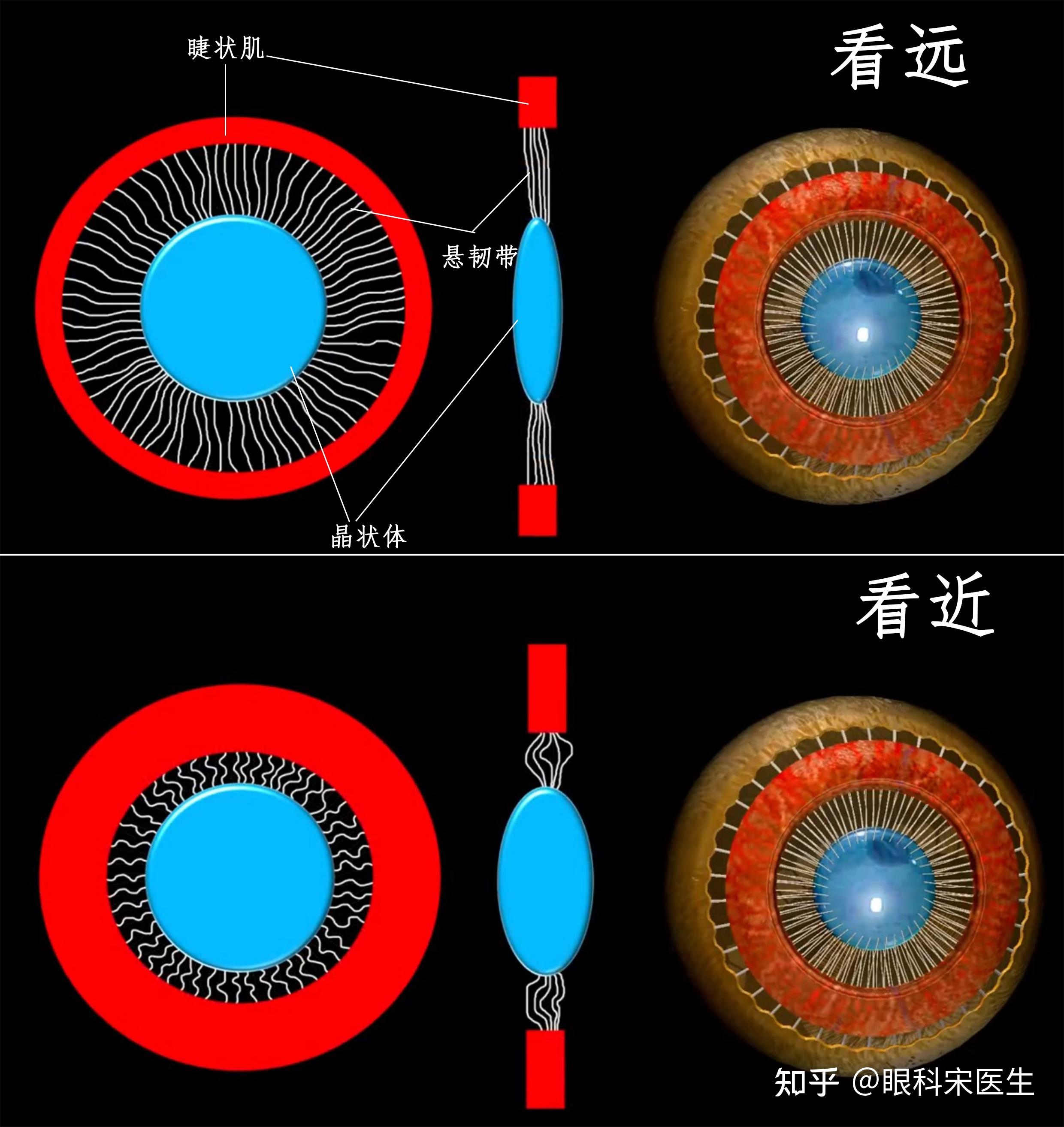 这睫状肌的收缩不是拉紧悬韧带的作用,而是放松,从而使得晶体变凸