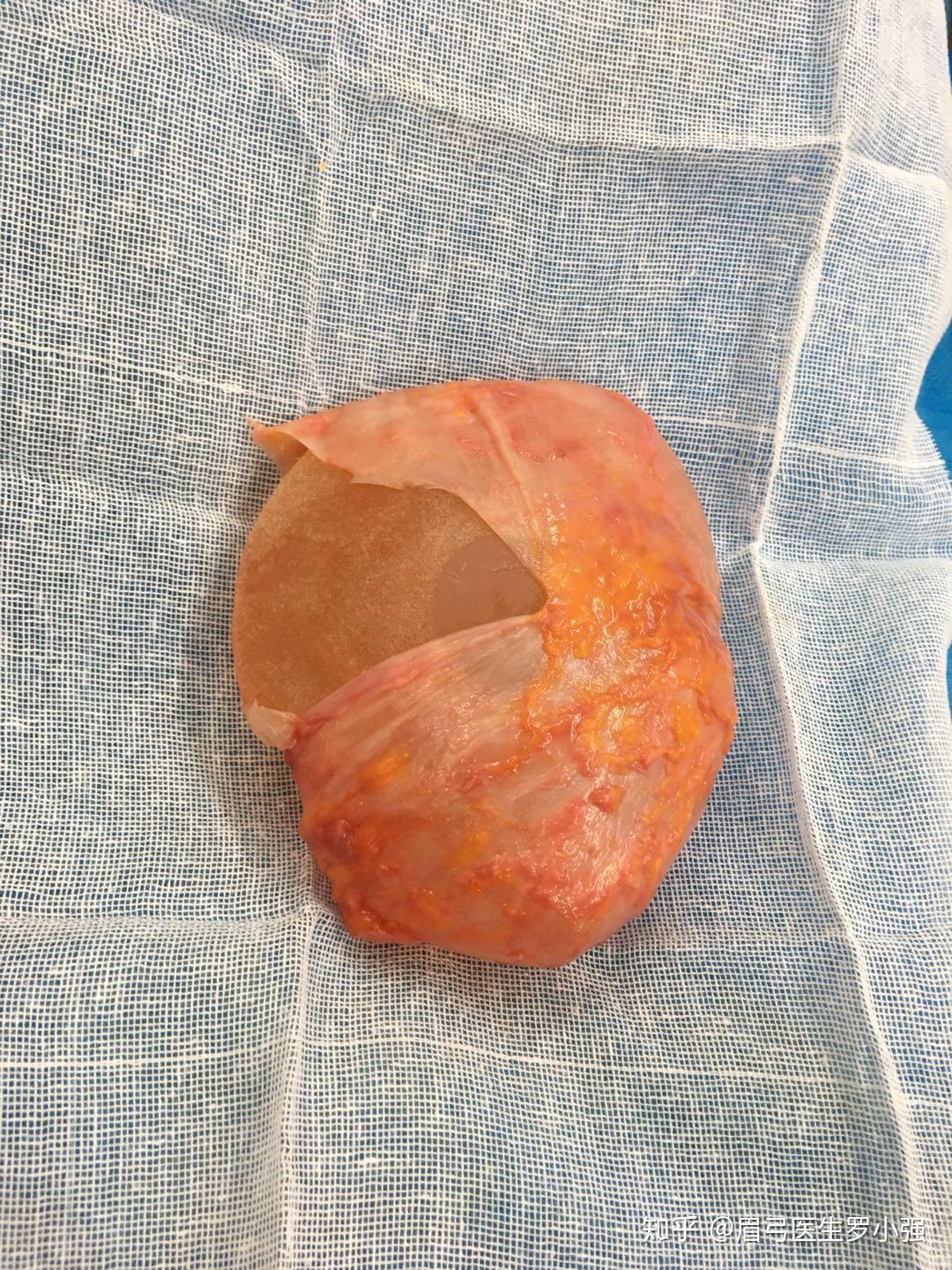 假体隆胸后如果出现包膜挛缩怎么办