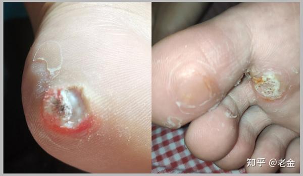 跖疣,鸡眼和跰趾跖疣是由hpv病毒(人类乳头瘤病毒)感染引起的,这种