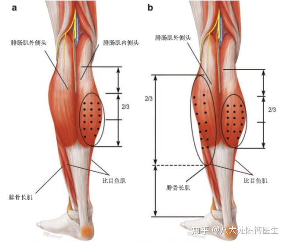 脂肪肌肉混合型小腿先吸脂還是先打瘦腿針