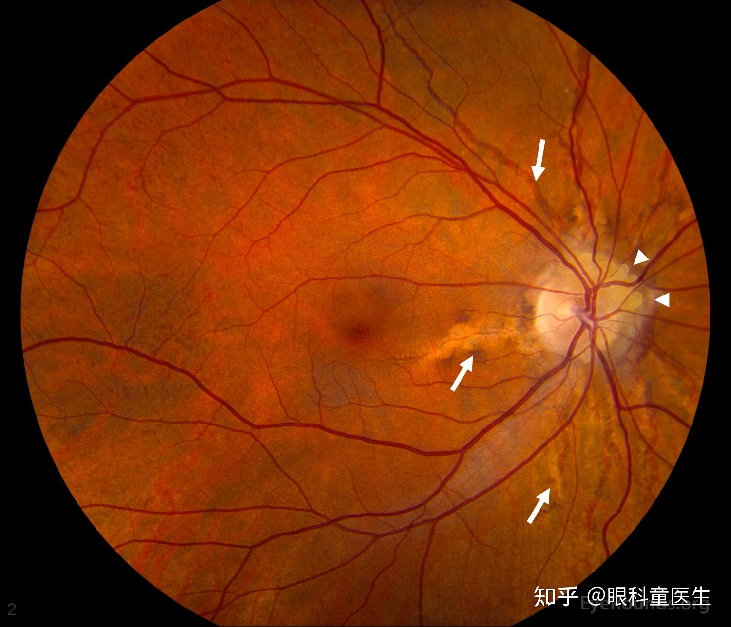 面向视网膜脱离手术的硅油填充模拟
