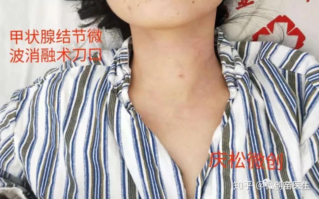 甲狀腺乳頭狀癌可以微波消融嗎