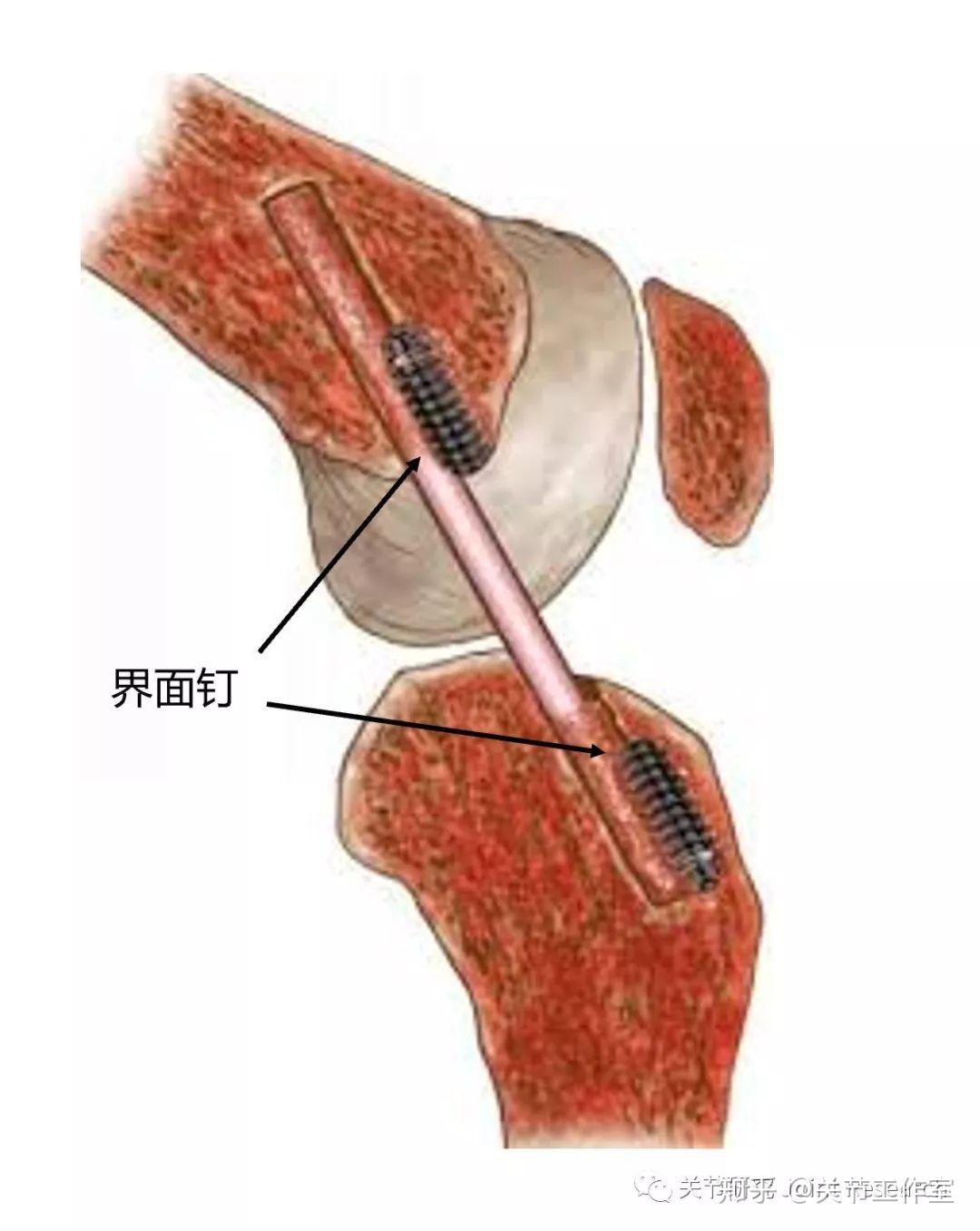 重建韧带的钉子位置图图片