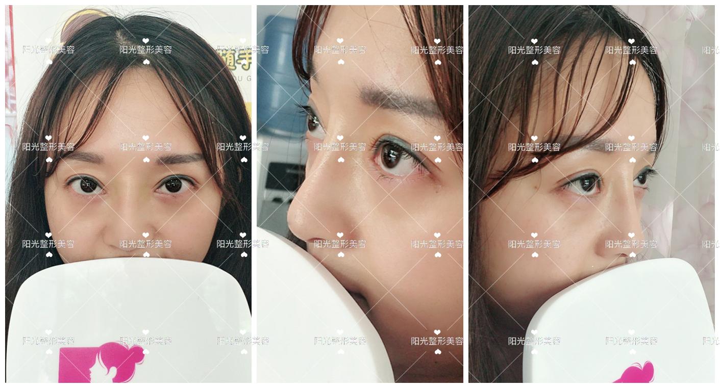眼综合 小鼻综合 效果惊艳到炸裂 知乎 眼综合 小鼻综合 效果惊艳到炸裂 知乎